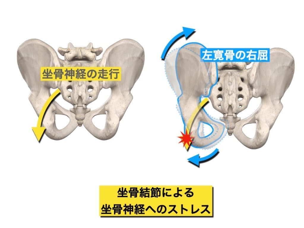 仙腸関節と坐骨神経